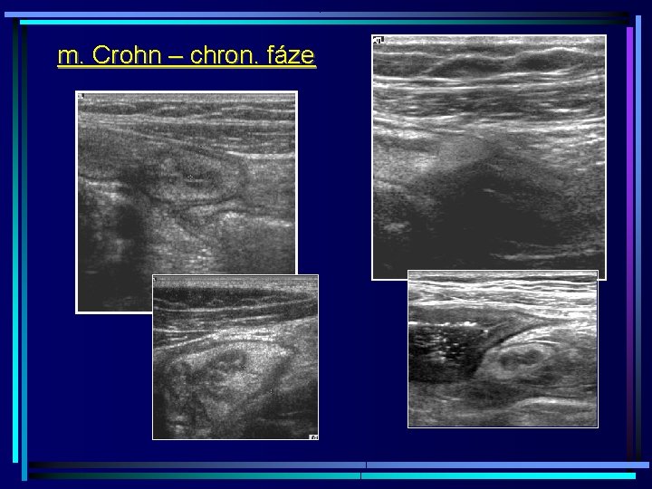 m. Crohn – chron. fáze 