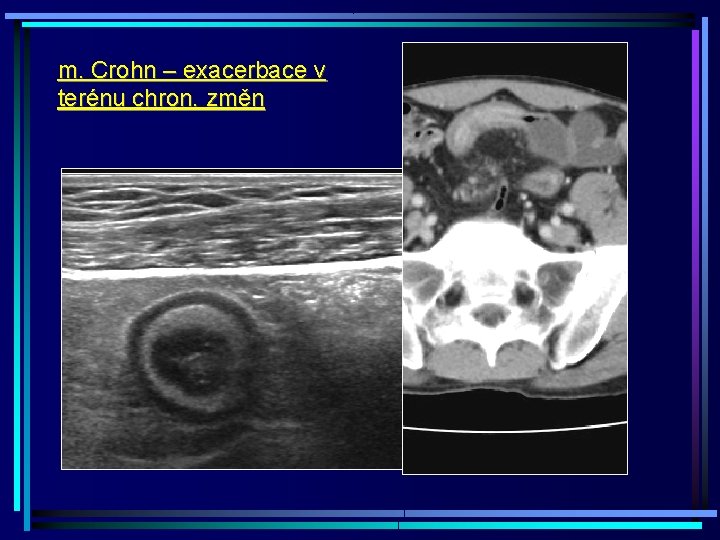 m. Crohn – exacerbace v terénu chron. změn 