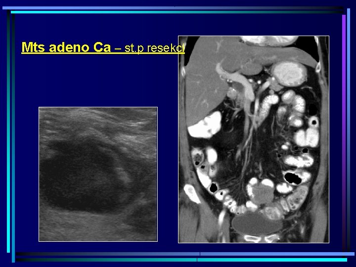 Mts adeno Ca – st. p resekci 