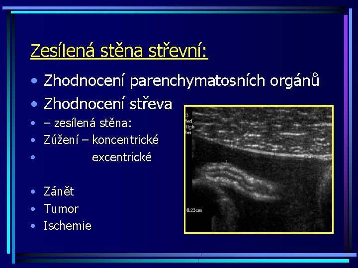 Zesílená stěna střevní: • Zhodnocení parenchymatosních orgánů • Zhodnocení střeva • – zesílená stěna: