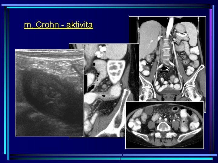 m. Crohn - aktivita 