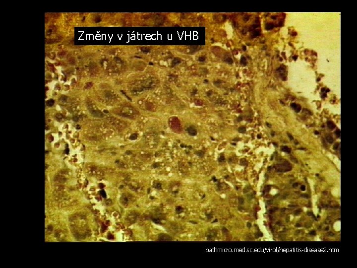 Změny v játrech u VHB pathmicro. med. sc. edu/virol/hepatitis-disease 2. htm 