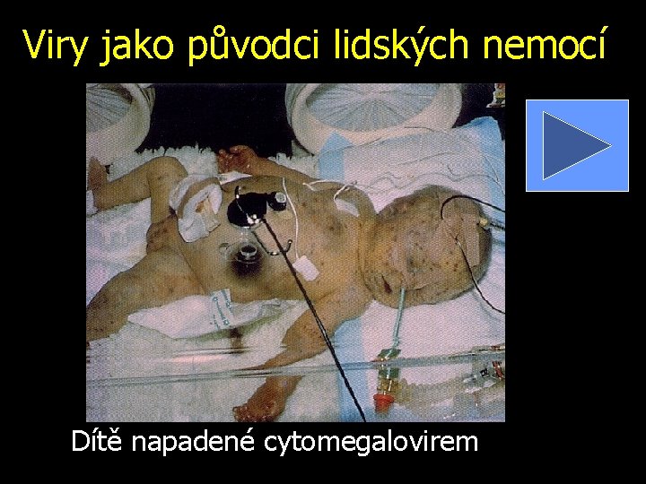 Viry jako původci lidských nemocí Dítě napadené cytomegalovirem 