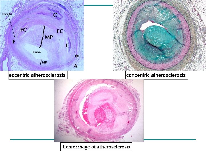 eccentric atherosclerosis concentric atherosclerosis hemorrhage of atherosclerosis 