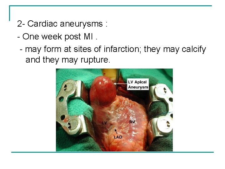 2 - Cardiac aneurysms : - One week post MI. - may form at
