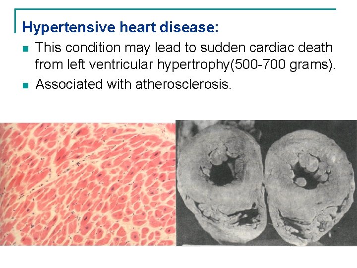 Hypertensive heart disease: n n This condition may lead to sudden cardiac death from
