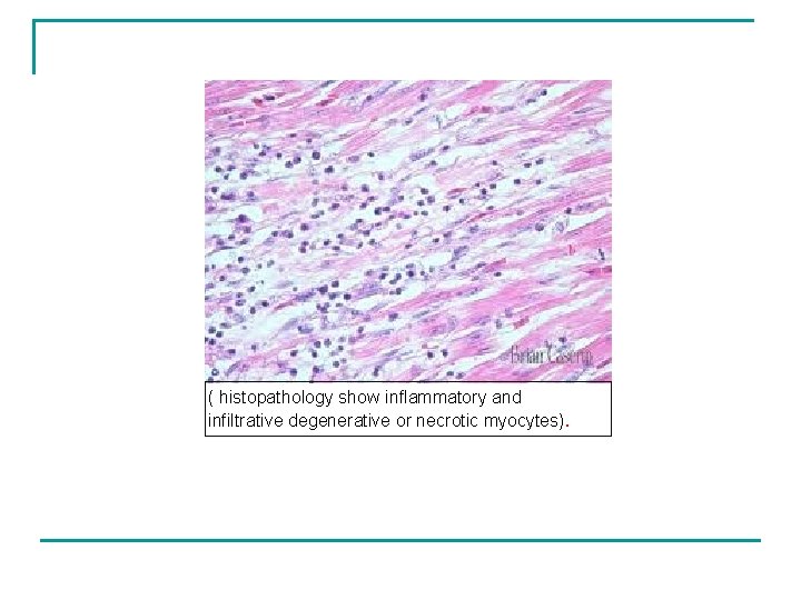 ( histopathology show inflammatory and infiltrative degenerative or necrotic myocytes). 