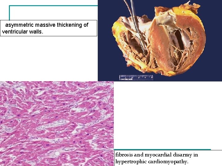 asymmetric massive thickening of ventricular walls. fibrosis and myocardial disarray in hypertrophic cardiomyopathy. 