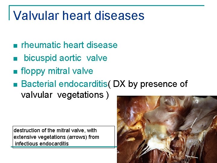 Valvular heart diseases n n rheumatic heart disease bicuspid aortic valve floppy mitral valve