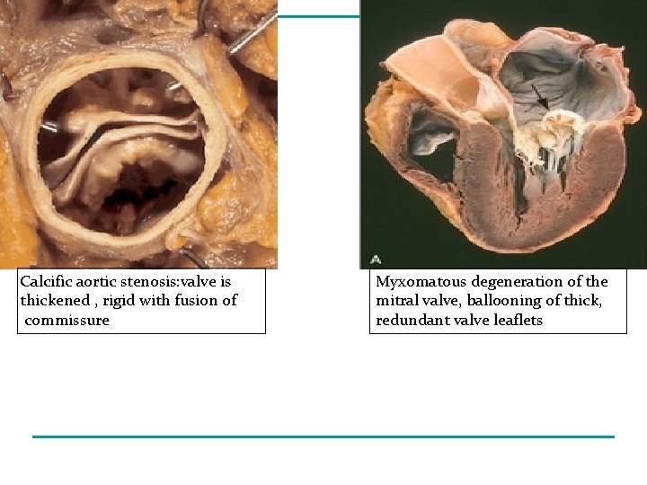 Calcific aortic stenosis: valve is thickened , rigid with fusion of commissure Myxomatous degeneration