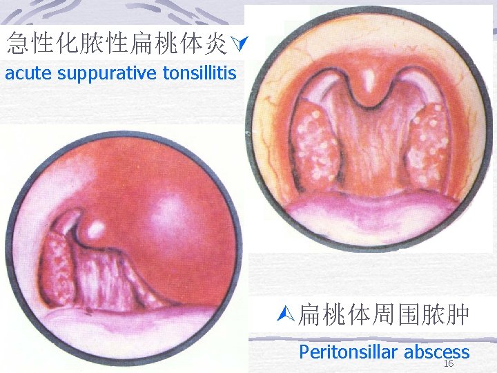 急性化脓性扁桃体炎 acute suppurative tonsillitis 扁桃体周围脓肿 Peritonsillar abscess 16 