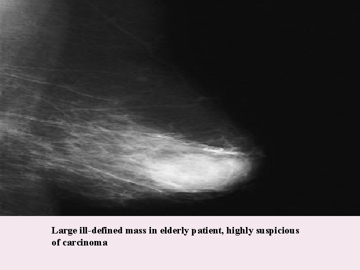 Large ill-defined mass in elderly patient, highly suspicious of carcinoma 