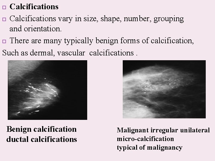 Calcifications vary in size, shape, number, grouping and orientation. There are many typically benign