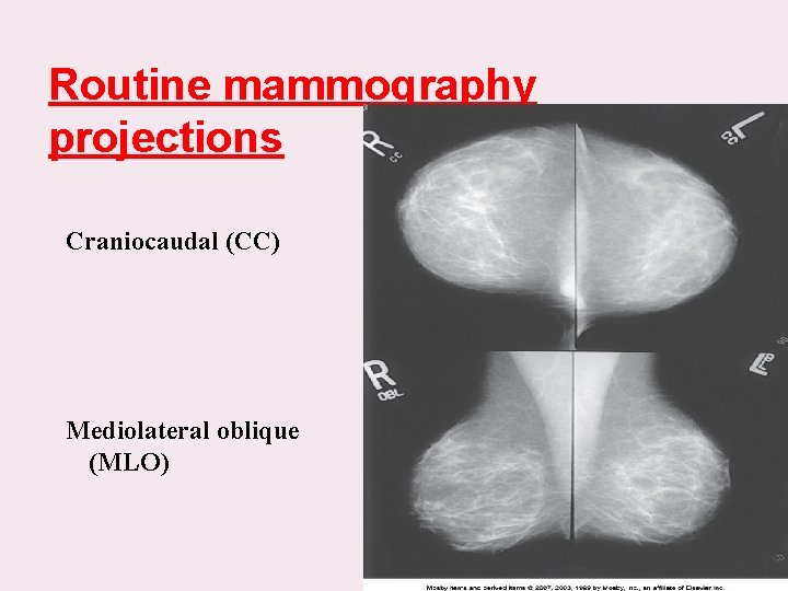 Routine mammography projections Craniocaudal (CC) Mediolateral oblique (MLO) 
