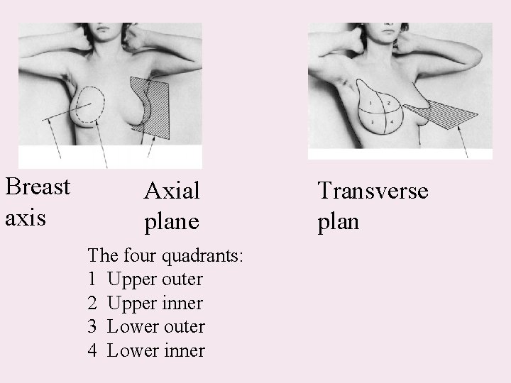Breast axis Axial plane The four quadrants: 1 Upper outer 2 Upper inner 3