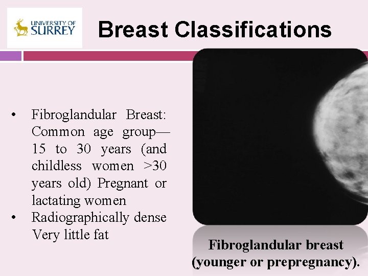 Breast Classifications • • Fibroglandular Breast: Common age group— 15 to 30 years (and