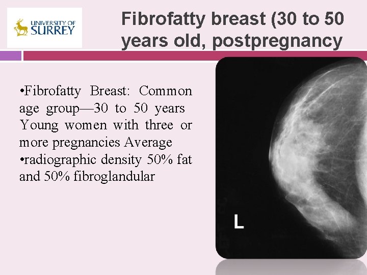 Fibrofatty breast (30 to 50 years old, postpregnancy • Fibrofatty Breast: Common age group—