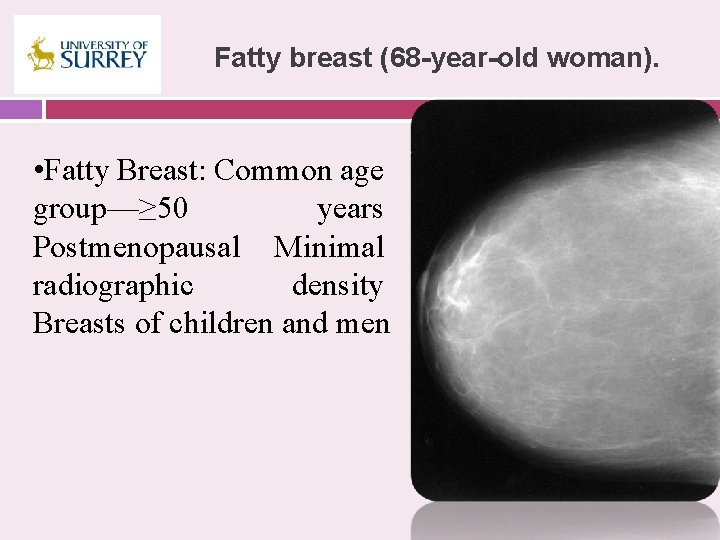 Fatty breast (68 -year-old woman). • Fatty Breast: Common age group—≥ 50 years Postmenopausal