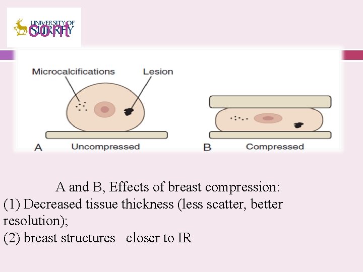 cont A and B, Effects of breast compression: (1) Decreased tissue thickness (less scatter,
