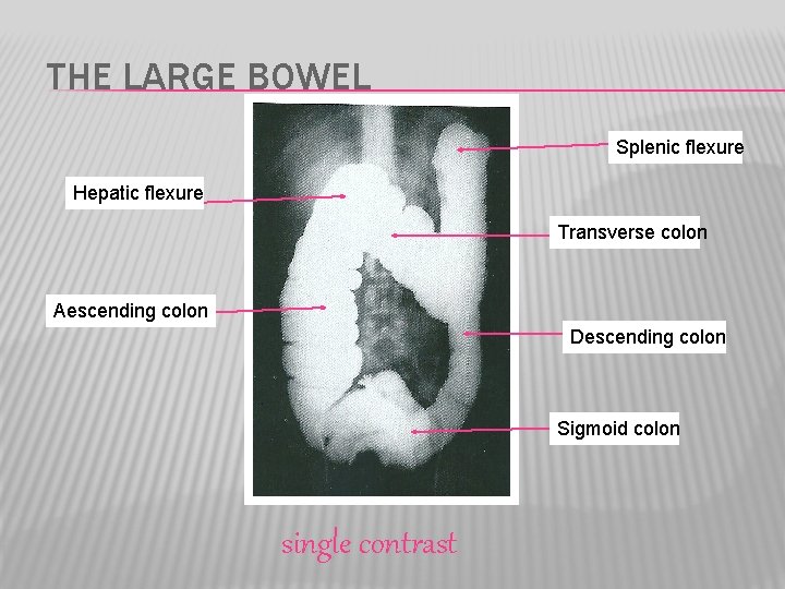 THE LARGE BOWEL Splenic flexure Hepatic flexure Transverse colon Aescending colon Descending colon Sigmoid