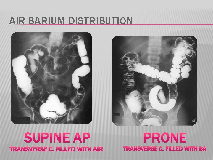 AIR BARIUM DISTRIBUTION 