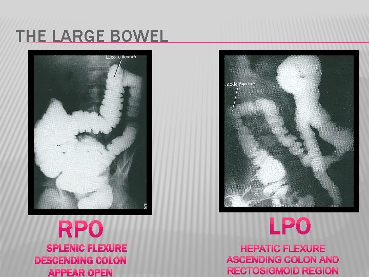 THE LARGE BOWEL 