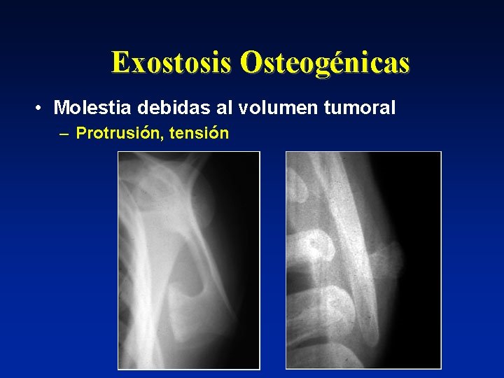 Exostosis Osteogénicas • Molestia debidas al volumen tumoral – Protrusión, tensión 