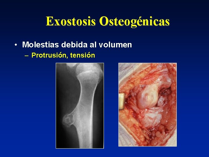 Exostosis Osteogénicas • Molestias debida al volumen – Protrusión, tensión 