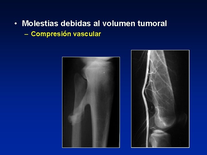  • Molestias debidas al volumen tumoral – Compresión vascular 