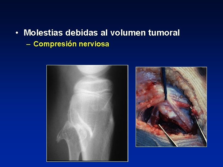  • Molestias debidas al volumen tumoral – Compresión nerviosa 