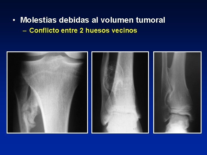  • Molestias debidas al volumen tumoral – Conflicto entre 2 huesos vecinos 