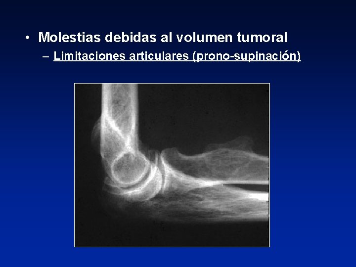  • Molestias debidas al volumen tumoral – Limitaciones articulares (prono-supinación) 