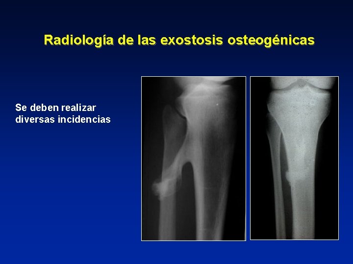 Radiología de las exostosis osteogénicas Se deben realizar diversas incidencias 