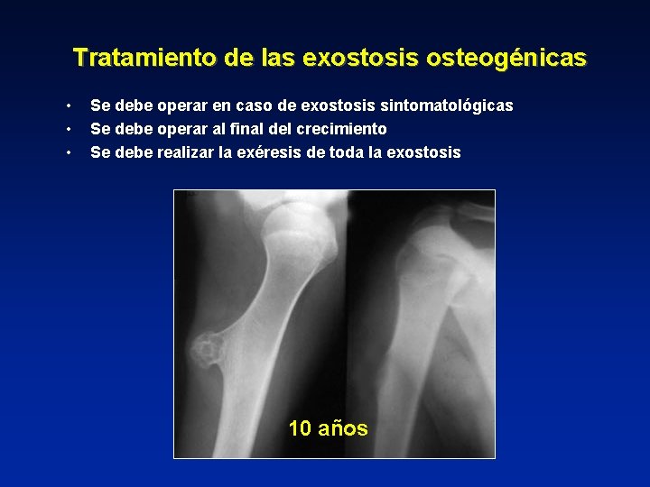 Tratamiento de las exostosis osteogénicas • • • Se debe operar en caso de