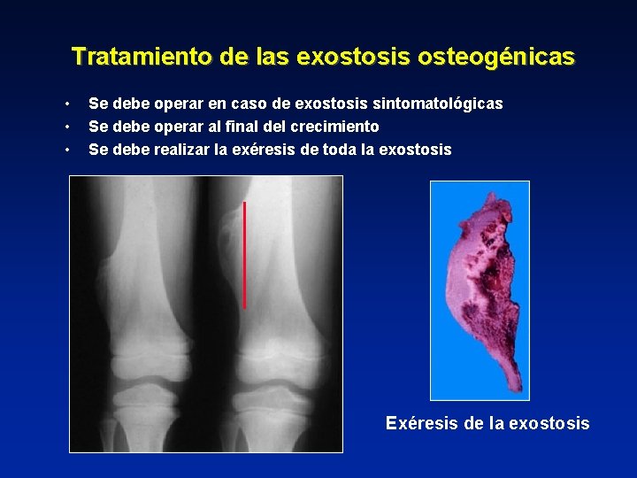 Tratamiento de las exostosis osteogénicas • • • Se debe operar en caso de