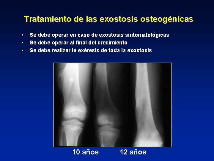 Tratamiento de las exostosis osteogénicas • • • Se debe operar en caso de