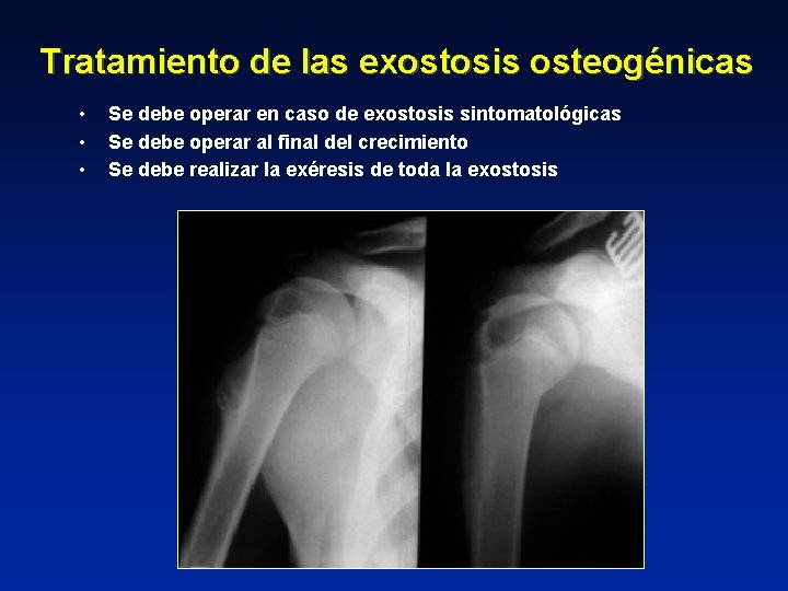 Tratamiento de las exostosis osteogénicas • • • Se debe operar en caso de