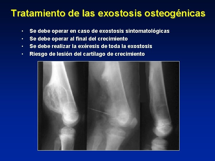 Tratamiento de las exostosis osteogénicas • • Se debe operar en caso de exostosis