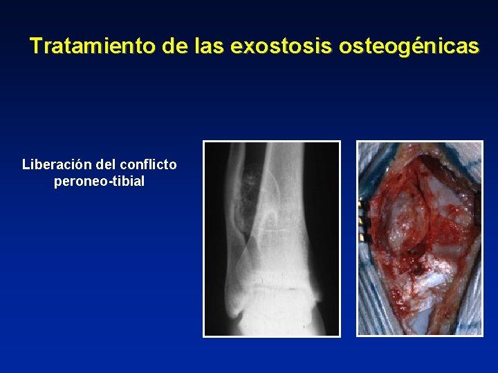 Tratamiento de las exostosis osteogénicas Liberación del conflicto peroneo-tibial 