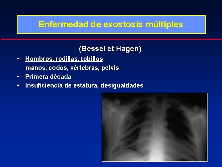 Enfermedad de exostosis múltiples (Bessel et Hagen) • Hombros, rodillas, tobillos manos, codos, vértebras,