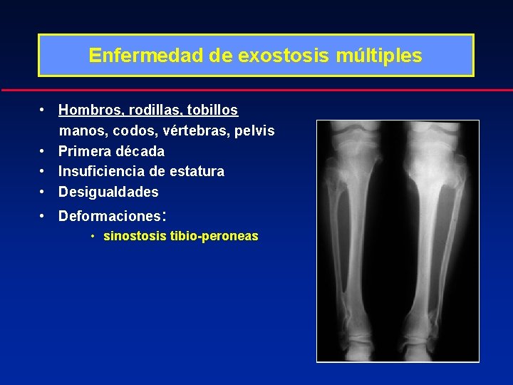 Enfermedad de exostosis múltiples • Hombros, rodillas, tobillos manos, codos, vértebras, pelvis • Primera