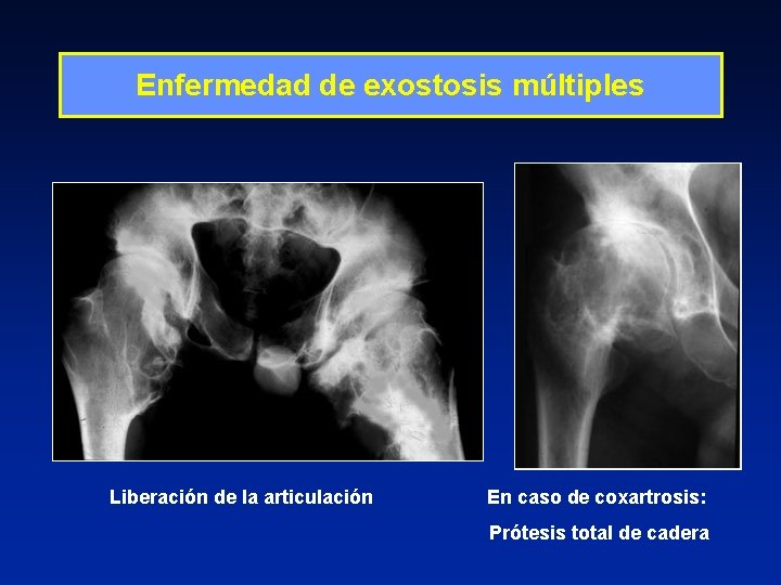 Enfermedad de exostosis múltiples Liberación de la articulación En caso de coxartrosis: Prótesis total