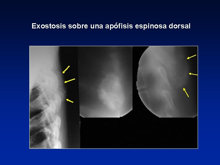 Exostosis sobre una apófisis espinosa dorsal 