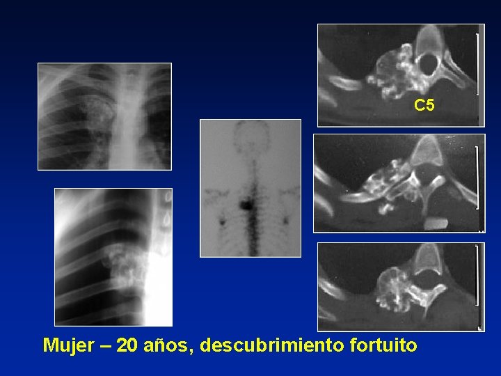 C 5 Mujer – 20 años, descubrimiento fortuito 