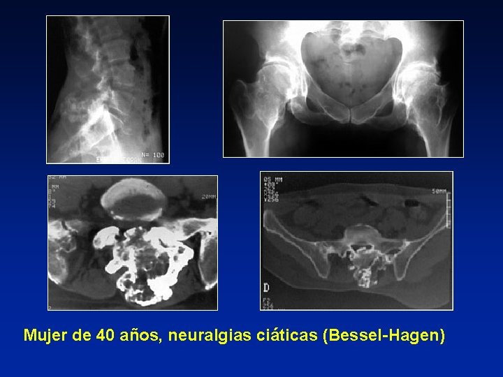 Mujer de 40 años, neuralgias ciáticas (Bessel-Hagen) 