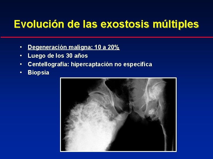 Evolución de las exostosis múltiples • • Degeneración maligna: 10 a 20% Luego de