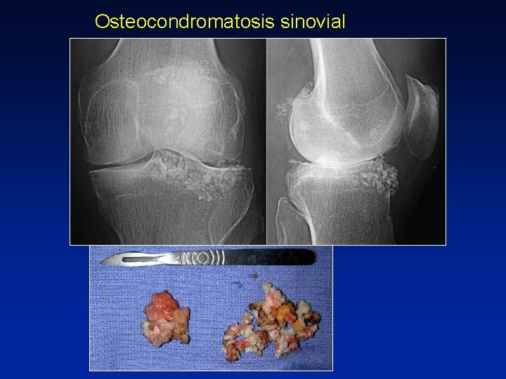 Osteocondromatosis sinovial 