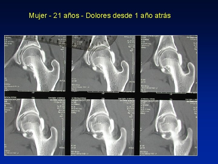 Mujer - 21 años - Dolores desde 1 año atrás 