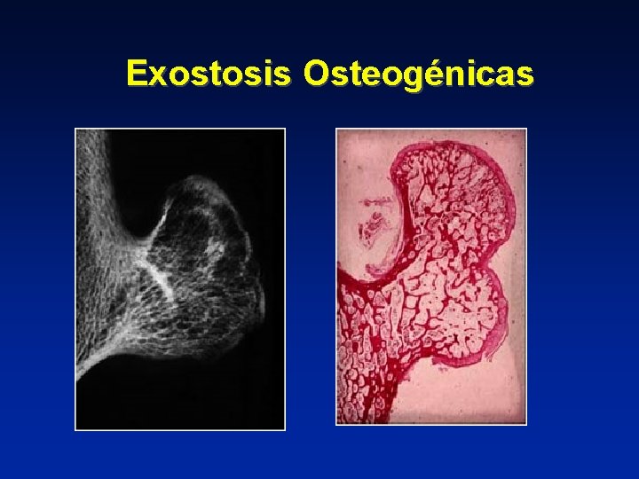 Exostosis Osteogénicas 