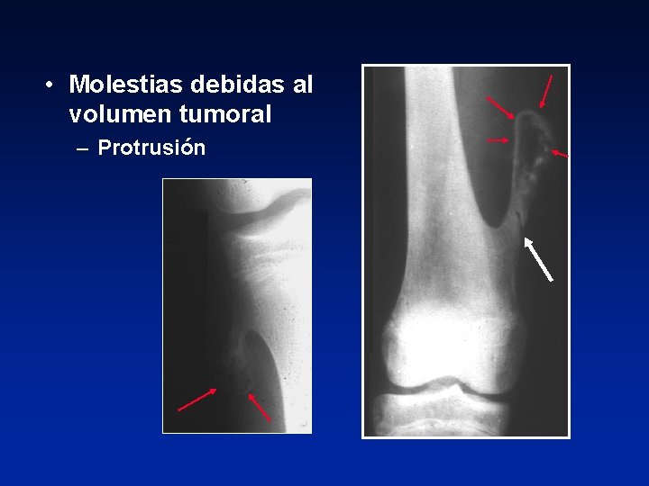  • Molestias debidas al volumen tumoral – Protrusión 